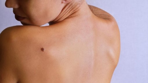 Noventa mil casos de cancro da pele em cinco anos, segundo um estudo