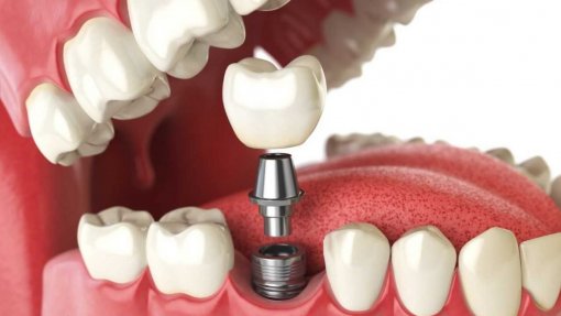 Infarmed alerta para utilização de pilares para implantes dentários