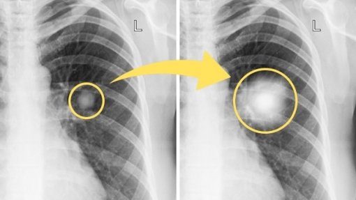 Tecnologia criada no Porto ajuda médicos a identificar nódulos pulmonares