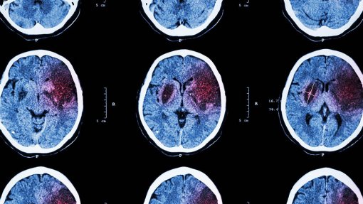 Doentes cardiovasculares não mudam comportamentos após AVC ou enfarte - Estudo