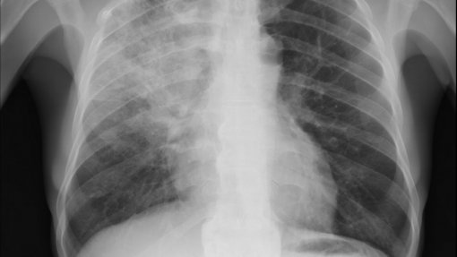 Pneumonia causou 5,1% das mortes registadas em 2018 - INE