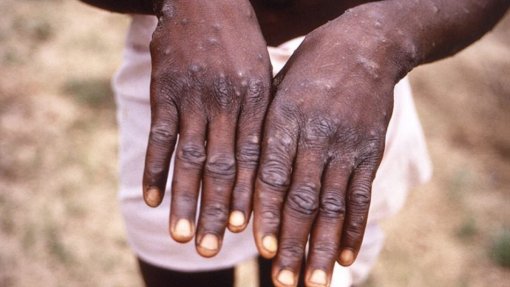Burundi regista primeiros casos de varíola dos macacos