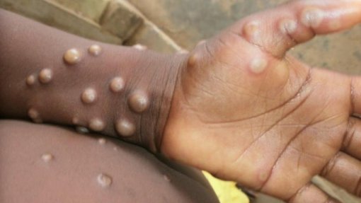 Mpox: Mais de 18.700 casos suspeitos ou confirmados em África desde início do ano