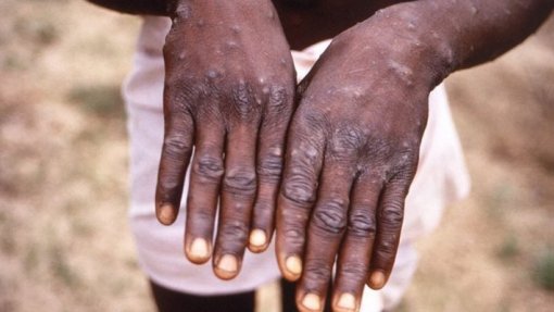 Mpox: Unicef pede 14,8 ME para conter surto na África Oriental e Austral