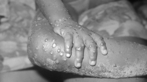 Mpox: Autoridades provinciais moçambicanas vão criar centros de isolamento