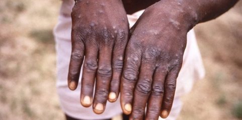 Mpox: OMS dá luz verde a teste para diagnosticar a doença