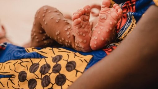 Mpox: Doença já infetou 38.300 pessoas e matou 979 desde o início do ano em África