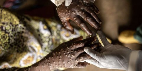 Mpox: Número de mortos ultrapassou os mil - CDC África