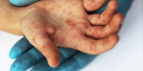 Mpox: África regista 1.083 mortes desde o início de 2024 em 19 países - CDC