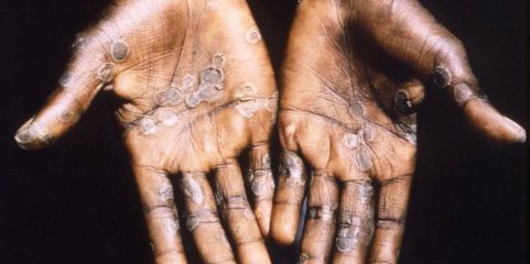 Mpox: África registou quase 78.000 casos e 1.321 mortes desde início de 2024