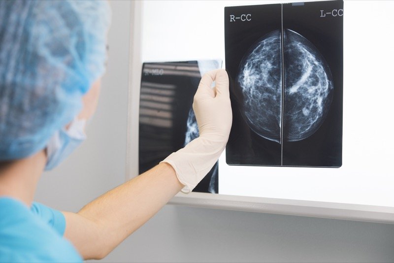 Les femmes à faible revenu participent moins au dépistage du cancer